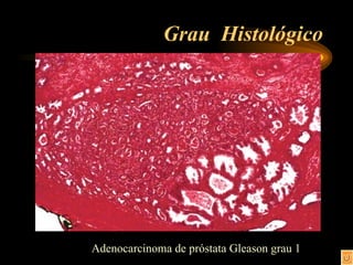 Grau  Histológico Adenocarcinoma de próstata Gleason grau 1 