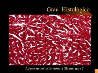 Grau  Histológico Adenocarcinoma de próstata Gleason grau 2 