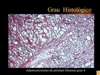 Grau  Histológico Adenocarcinoma de próstata Gleason grau 4 