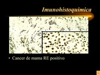Imunohistoquimica Cancer de mama RE positivo 