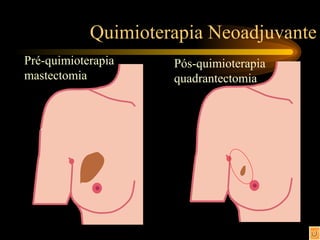 Quimioterapia Neoadjuvante Pré-quimioterapia mastectomia Pós-quimioterapia quadrantectomia 