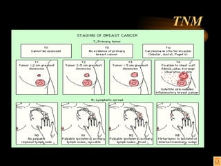 TNM 