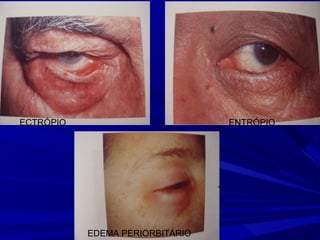 ECTRÓPIO                         ENTRÓPIO




           EDEMA PERIORBITÁRIO
 