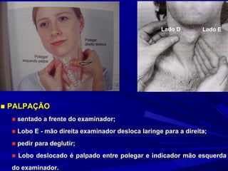 EXAME DO PESCOÇO



                                                   Lado D        Lado E




■ PALPAÇÃO
  ■ sentado a frente do examinador;
  ■ Lobo E - mão direita examinador desloca laringe para a direita;
  ■ pedir para deglutir;
  ■ Lobo deslocado é palpado entre polegar e indicador mão esquerda
  do examinador.
 