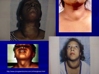 http://www.cirurgiaendocrina.com.br/tireoglosso.html
 