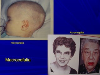 Acromegalia



  Hidrocefalia




Macrocefalia
 