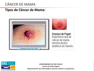 CÂNCER DE MAMA
Tipos de Câncer de Mama:
Saúde da Mulher • Profa. Dra. Carla Marins
 