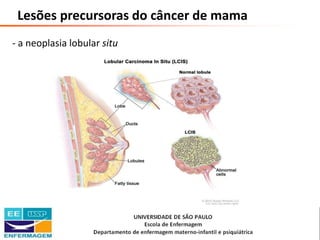 Saúde da Mulher • Profa. Dra. Carla Marins
Lesões precursoras do câncer de mama
- a neoplasia lobular situ
 