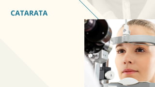 CATARATA
 
