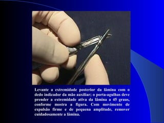 Levante a extremidade posterior da lâmina com o
dedo indicador da mão auxiliar; o porta-agulhas deve
prender a extremidade ativa da lâmina a 45 graus,
conforme mostra a figura. Com movimento de
expulsão firme e de pequena amplitude, remover
cuidadosamente a lâmina.
 