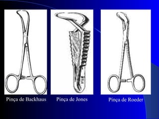 Pinça de Backhaus Pinça de Jones Pinça de Roeder
 