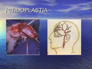 RITIDOPLASTIA
 