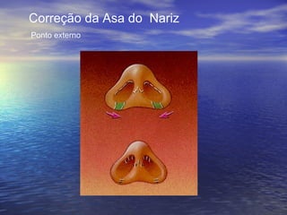 Correção da Asa do Nariz
Ponto externo
 