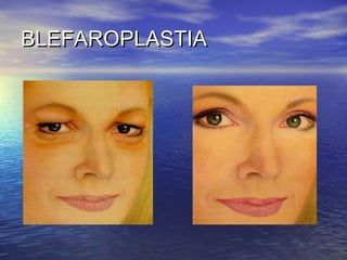 BLEFAROPLASTIA
 