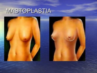 MASTOPLASTIA
 