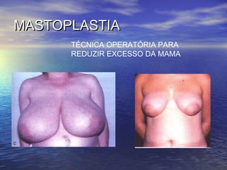 MASTOPLASTIA
      TÉCNICA OPERATÓRIA PARA
      REDUZIR EXCESSO DA MAMA
 