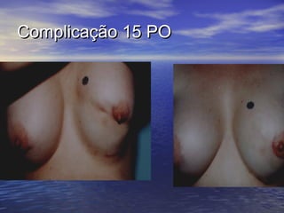 Complicação 15 PO
 