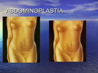 ABDOMINOPLASTIA
 