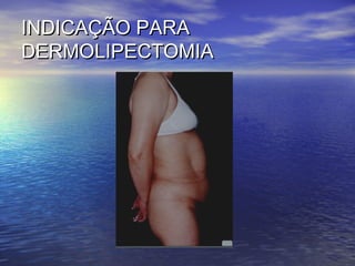 INDICAÇÃO PARA
DERMOLIPECTOMIA
 