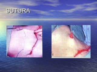 SUTURA
 