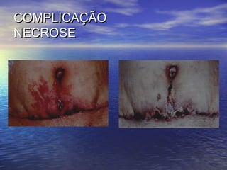COMPLICAÇÃO
NECROSE
 