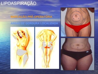 LIPOASPIRAÇÃO

   MARCAÇÃO PRÉ-OPERATÓRIA

   ÁREAS DE GORDURA LOCALIZADA
 