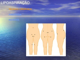LIPOASPIRAÇÃO
   TÉCNICA CIRÚRGICA

   ANESTESIA

   INCISÕES
 