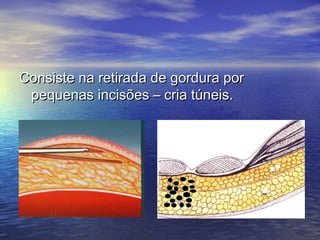 Consiste na retirada de gordura por
 pequenas incisões – cria túneis.
 