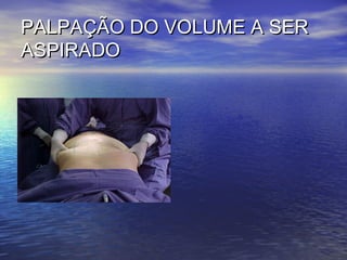 PALPAÇÃO DO VOLUME A SER
ASPIRADO
 