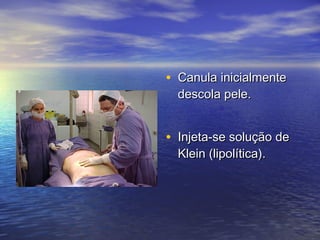 • Canula inicialmente
  descola pele.


• Injeta-se solução de
  Klein (lipolítica).
 