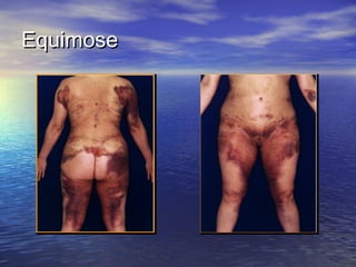Equimose
 