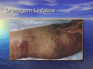Drenagem Linfática
 