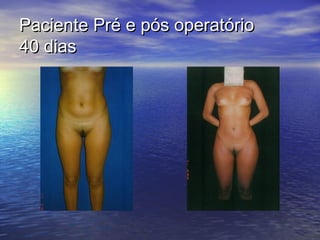 Paciente Pré e pós operatório
40 dias
 