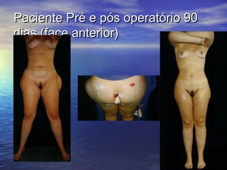 Paciente Pré e pós operatório 90
dias (face anterior)
 