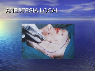 ANESTESIA LOCAL
 