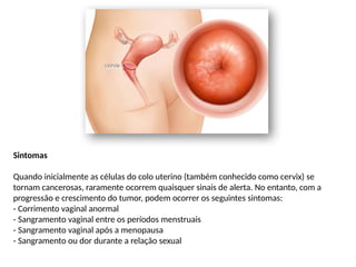 Sintomas
Quando inicialmente as células do colo uterino (também conhecido como cervix) se
tornam cancerosas, raramente ocorrem quaisquer sinais de alerta. No entanto, com a
progressão e crescimento do tumor, podem ocorrer os seguintes sintomas:
- Corrimento vaginal anormal
- Sangramento vaginal entre os períodos menstruais
- Sangramento vaginal após a menopausa
- Sangramento ou dor durante a relação sexual
 