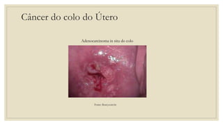 Câncer do colo do Útero
Fonte: fleury.com.br
Adenocarcinoma in situ do colo
 