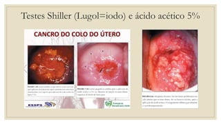 Testes Shiller (Lugol=iodo) e ácido acético 5%
 
