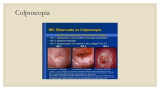 Colposcopia
 