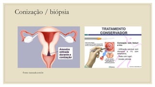 Conização / biópsia
Fonte: tuasaude.com.br
 