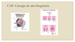 CAF: Cirurgia de alta frequência
 