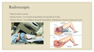 Radioterapia
◦ Pode ser interna e externa
◦ Interna: Cérvice (1 ou 2 sessões intracavitárias com intervalo de 15 dias)
◦ Externa: Cérvice + vasos linfáticos da parede lateral pélvica (ambulatorial, 5 dias por semana, por 6 sem)
 
