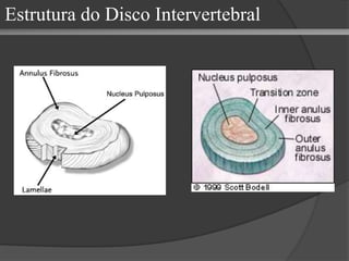 Estrutura do Disco Intervertebral 