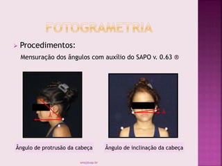  Procedimentos:
Mensuração dos ângulos com auxílio do SAPO v. 0.63 ®
Å
Å
Ângulo de protrusão da cabeça Ângulo de inclinação da cabeça
smaj@usp.br
 