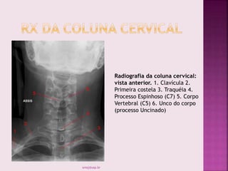 Radiografia da coluna cervical:
vista anterior. 1. Clavícula 2.
Primeira costela 3. Traquéia 4.
Processo Espinhoso (C7) 5. Corpo
Vertebral (C5) 6. Unco do corpo
(processo Uncinado)
smaj@usp.br
 
