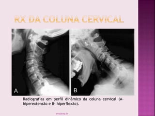 Radiografias em perfil dinâmico da coluna cervical (A-
hiperextensão e B- hiperflexão).
smaj@usp.br
 
