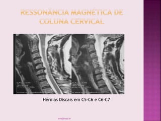 Hérnias Discais em C5-C6 e C6-C7
smaj@usp.br
 