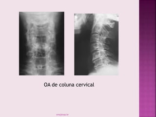 OA de coluna cervical
smaj@usp.br
 