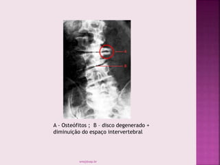 A - Osteófitos ; B – disco degenerado +
diminuição do espaço intervertebral
smaj@usp.br
 