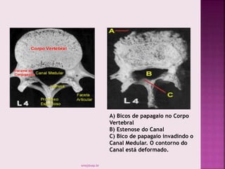 A) Bicos de papagaio no Corpo
Vertebral
B) Estenose do Canal
C) Bico de papagaio invadindo o
Canal Medular. O contorno do
Canal está deformado.
smaj@usp.br
 